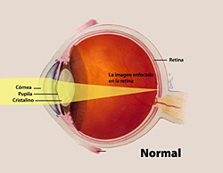 Errores Refractivos