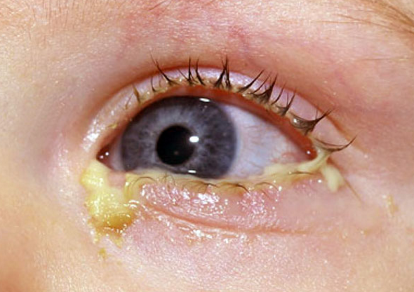 Conjuntivitis