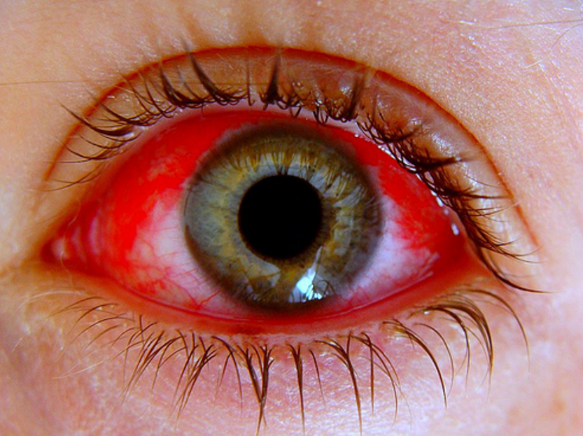 Conjuntivitis