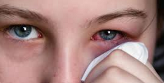 Conjuntivitis